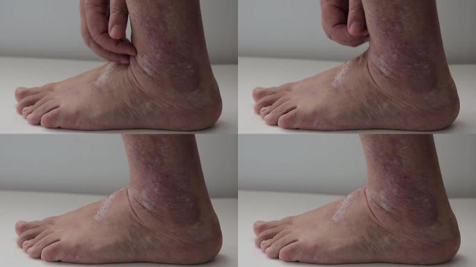 牛皮癣。一名男子梳理受银屑病斑块影响的足部区域