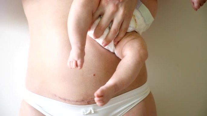 剖腹产疤痕的女人腹部特写。手上有婴儿的女人