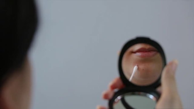 女人用棉签将奶油涂在镜子里脸上的丘疹上。特写。痤疮，发红，瑕疵，黑头。护肤，美容。青少年，荷尔蒙，油
