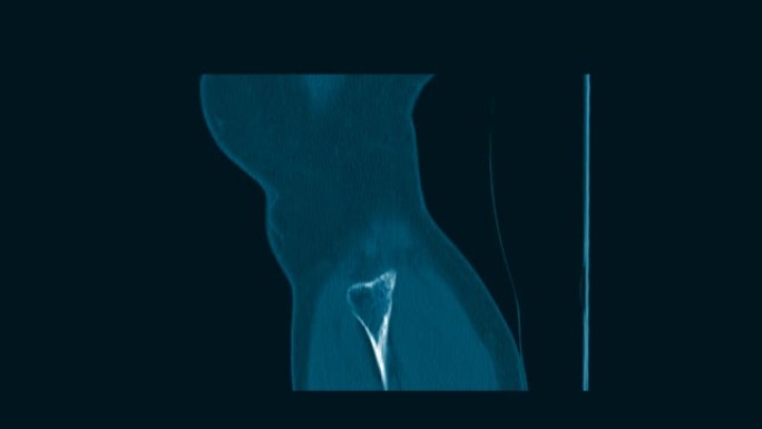 胫骨髁间隆起的CT膝关节骨折。