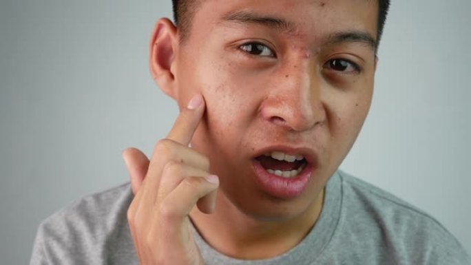 带有痤疮和皮肤问题的亚洲青少年的特写脸。健康和护肤概念。