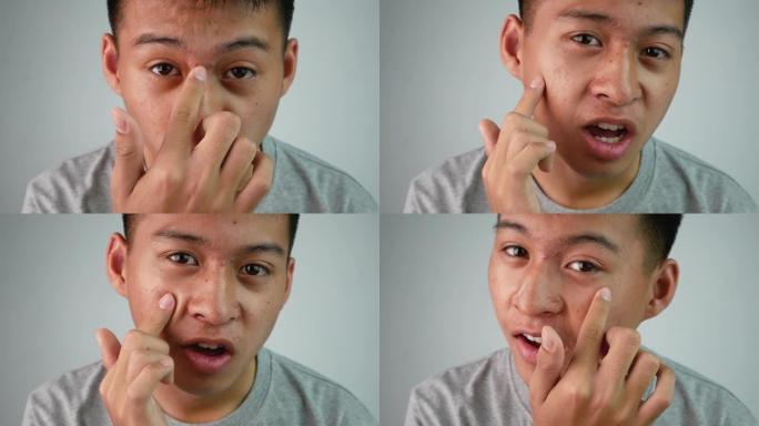 带有痤疮和皮肤问题的亚洲青少年的特写脸。健康和护肤概念。