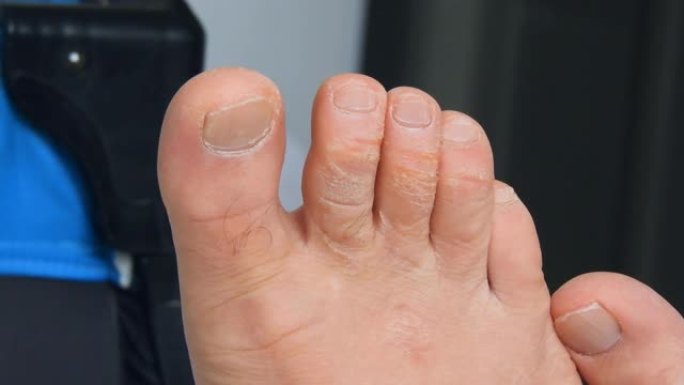 发生在脚趾上的酵母菌感染，