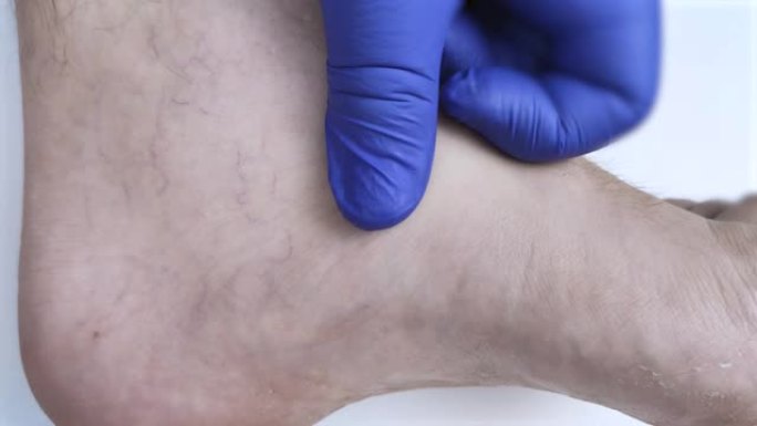 戴着蓝色医用手套的医生检查了患者腿上的真菌。在医院检查。1英尺真菌的宏观视频。