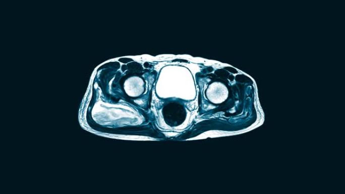 髋关节矢状面磁共振成像 (MRI)。在右臀大肌和臀中肌的肌内区域找到一个大型的混合异质液体集合。