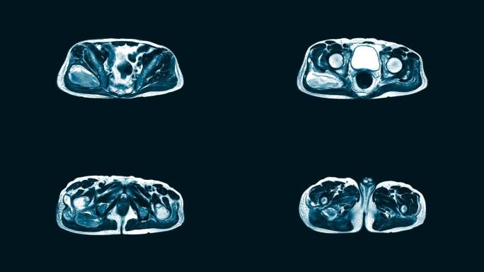 髋关节矢状面磁共振成像 (MRI)。在右臀大肌和臀中肌的肌内区域找到一个大型的混合异质液体集合。