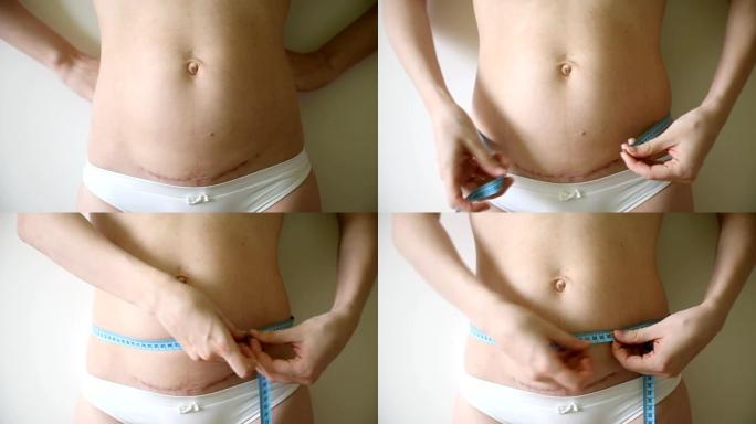 剖宫产妇女产后产后疤痕测量腰部