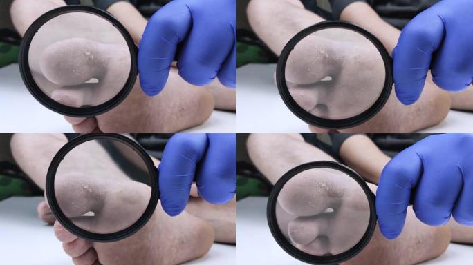 一个戴着蓝色医用手套的医生用放大镜检查病人腿上的真菌。在医院检查。足真菌的宏视频。