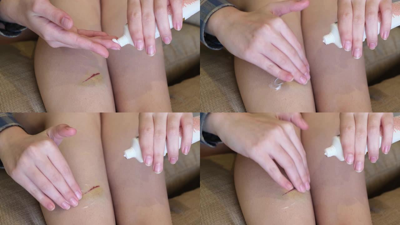 年轻女子用愈合霜涂抹伤口，腿上有瘀伤。