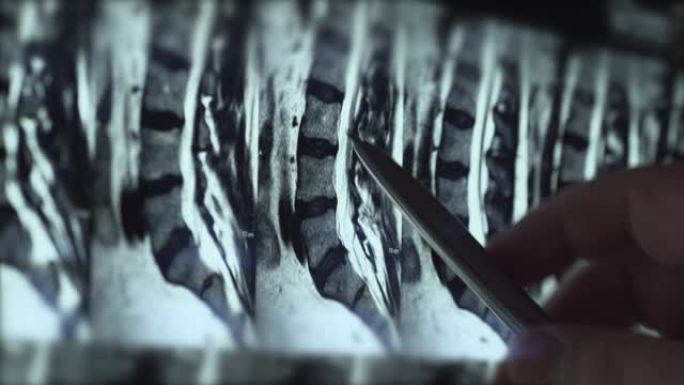 医生检查腰椎MRI，用脊柱和神经的夹片，用笔指向问题区域，特写