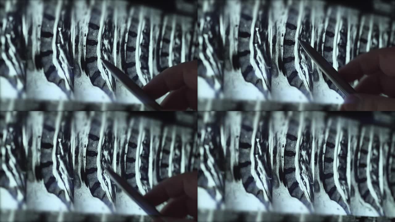 医生检查腰椎MRI，用脊柱和神经的夹片，用笔指向问题区域，特写
