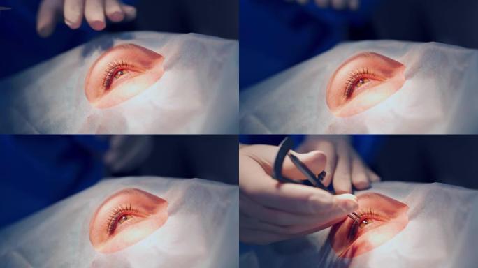 患者眼部治疗患者眼部治疗手术近视白内青光
