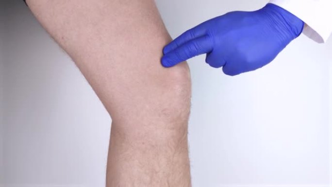 一个男人患有膝盖疼痛。由骨科医生和创伤医生检查。腿部红肿，半月板撕裂或膝盖滑囊炎