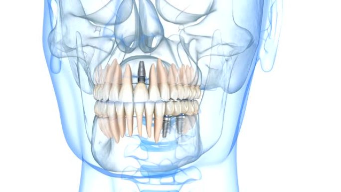 用牙科植入物恢复。人体牙齿和假牙概念的医学精确3D动画