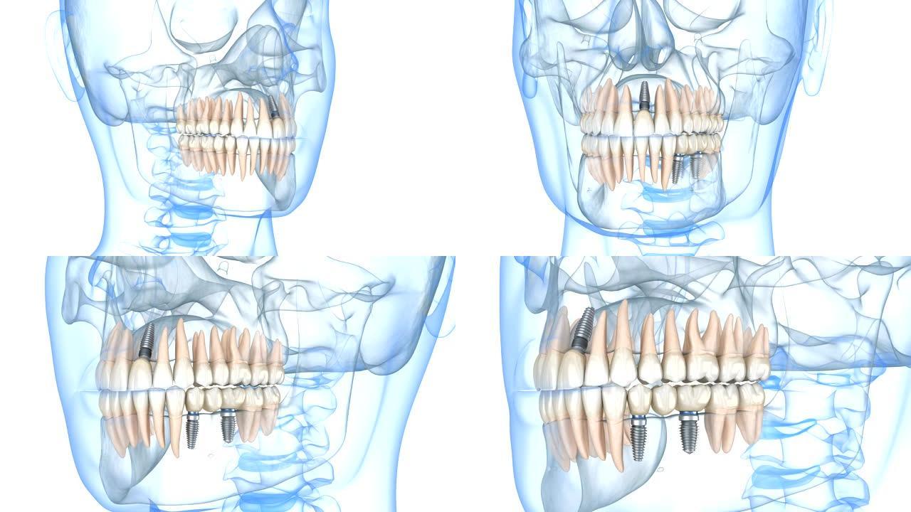 用牙科植入物恢复。人体牙齿和假牙概念的医学精确3D动画