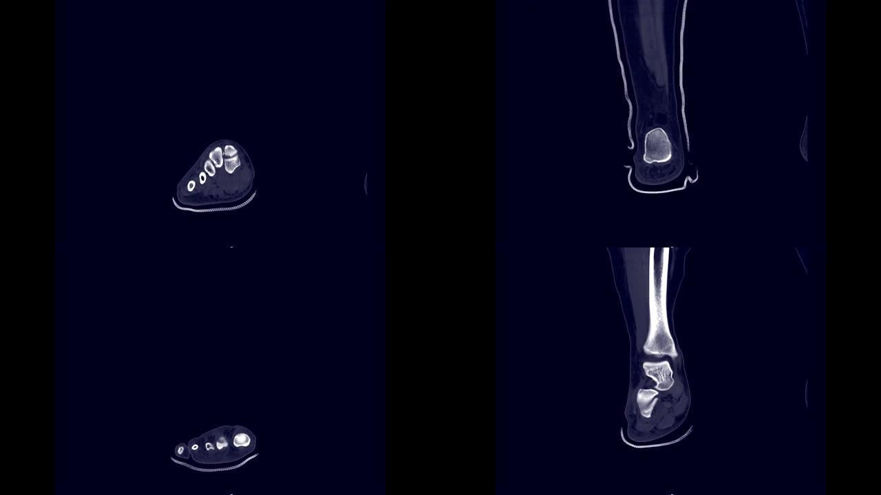 CT足部冠状视图用于诊断足部骨折。