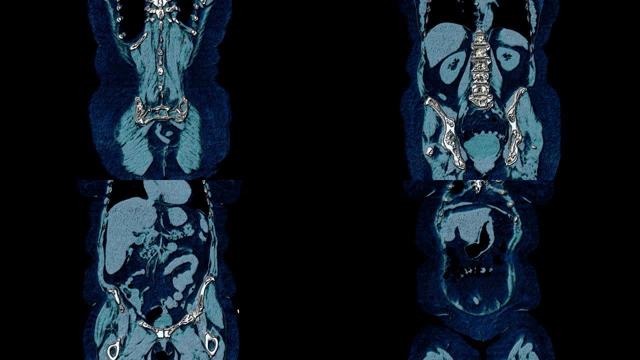 腹腔，胃肠道，膀胱的整体彩色MRI