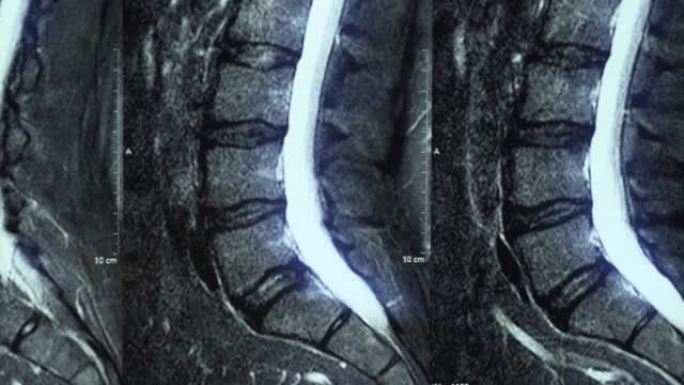 腰椎骨软骨病MRI的宏观全景，椎骨椎间盘和神经受累的年龄相关变化