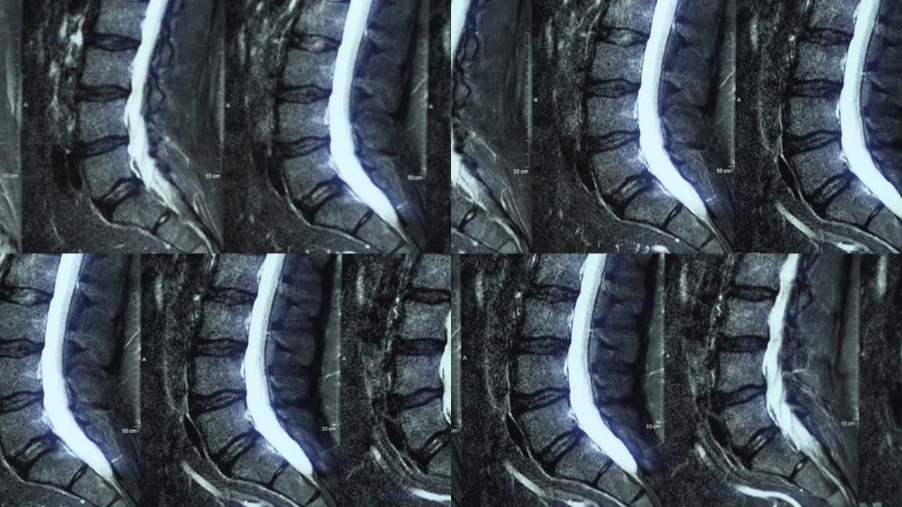 腰椎骨软骨病MRI的宏观全景，椎骨椎间盘和神经受累的年龄相关变化