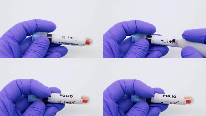 微生物学家或医务工作者用蓝色手术手套将血液检查结果标记为脊髓灰质炎阳性。脊髓灰质炎阳性概念