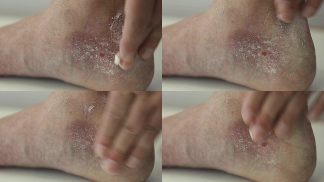 牛皮癣。该男子用银屑病斑块，皮疹和伤口将药膏摩擦到足部的患处。特写。