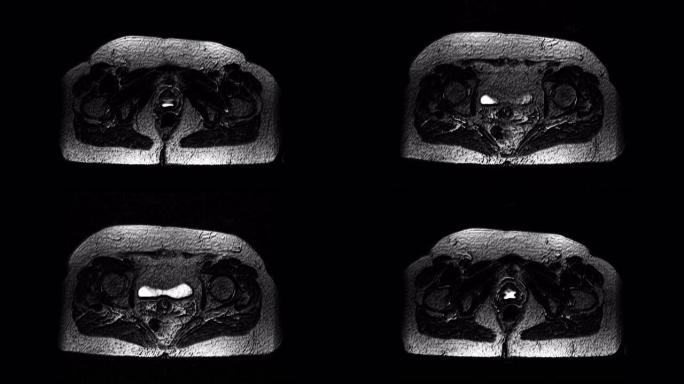 女性器官的术后大量MRI检测转移灶