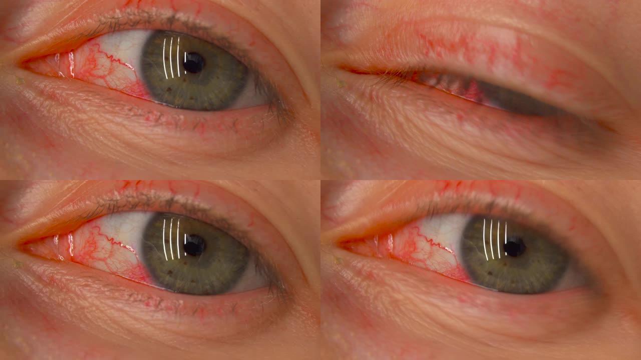 一个疲惫的红色血腥女人眼睛的特写。结膜炎女孩红眼。眼睛布满血丝的年轻女子。毛细血管人眼