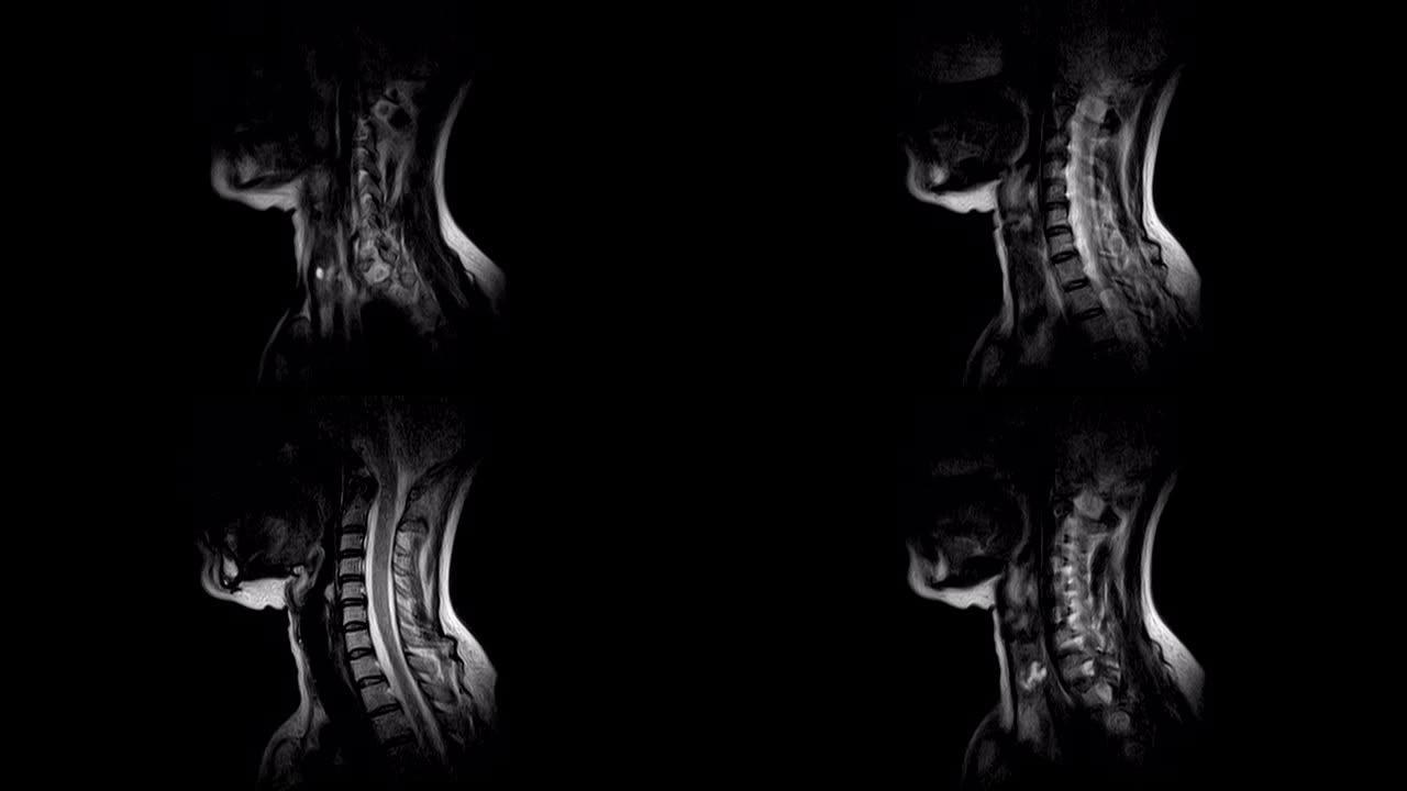 颈椎MRI，检测突起和疝气