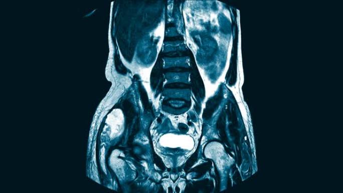 髋关节矢状面磁共振成像 (MRI)。在右臀大肌和臀中肌的肌内区域找到一个大型的混合异质液体集合。