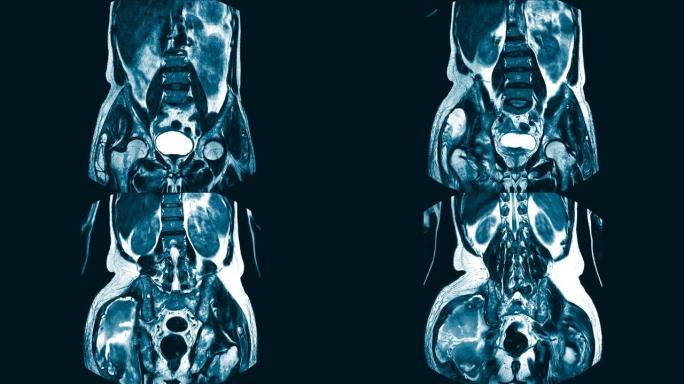 髋关节矢状面磁共振成像 (MRI)。在右臀大肌和臀中肌的肌内区域找到一个大型的混合异质液体集合。