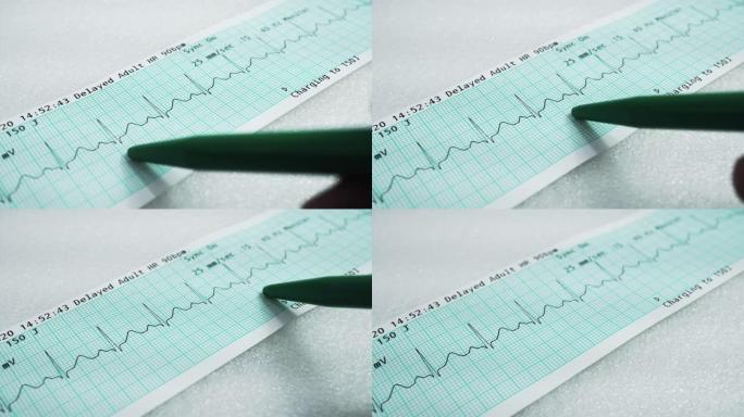 心电图报告心电疾病心脏检测