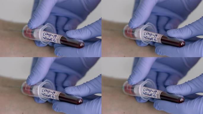 慢速Mo: 护士从可疑新型冠状病毒肺炎患者零采集血液样本-第3部分