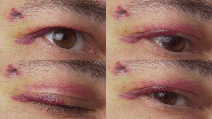 近距离观察眼睛附近的瘀伤，一个患有血肿的男人的脸