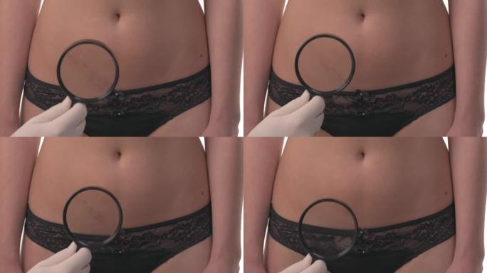 无法辨认的双手戴着手套用放大镜检查高加索妇女腹部的阑尾切除术疤痕。医疗保健概念。孤立在白色背景上。