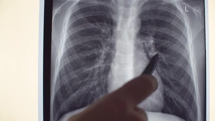 肺部x线