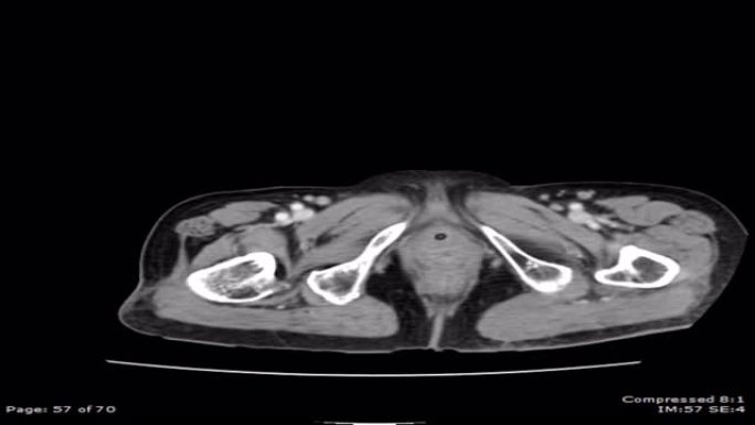 CT轴位造影诊断腹主动脉瘤4k