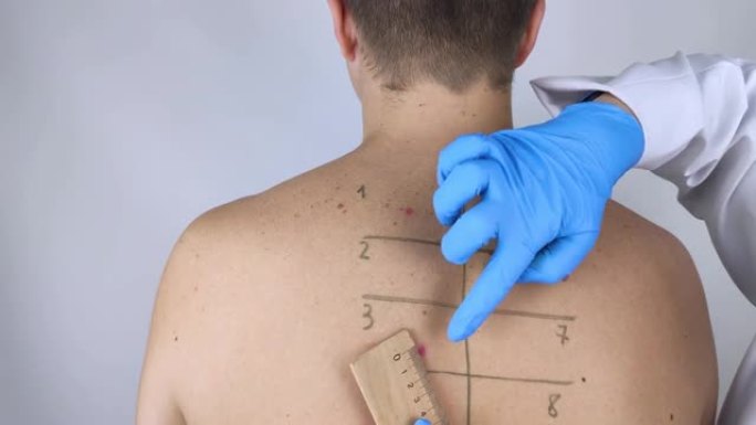 过敏症专家或皮肤科医生检查男人脸上的红点。男性患有皮疹，荨麻疹和瘙痒。食物过敏、昆虫叮咬、麻疹或水痘