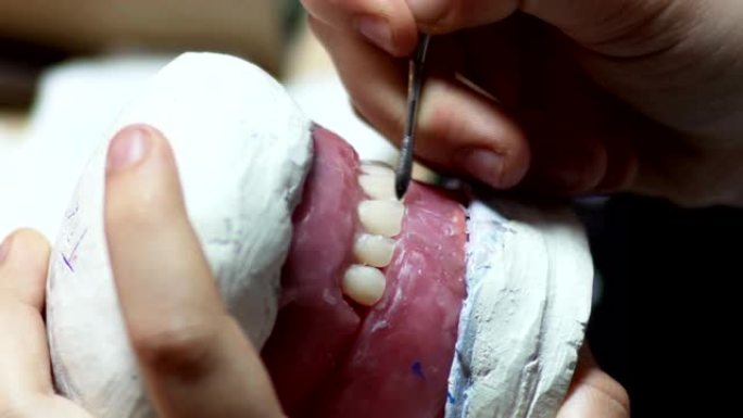 牙医研究牙齿假体模型