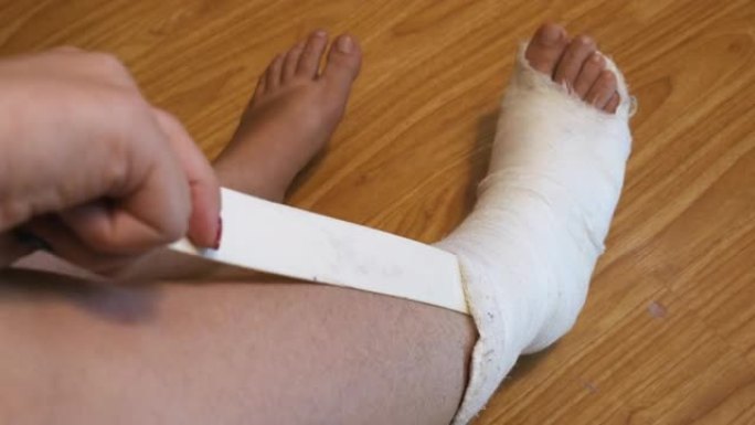 女人的腿在石膏上投射脚趾在移动。腿发痒。划伤了他的尺子腿。腿部骨折。