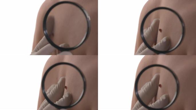 高加索女人背部痣的触诊。医生用放大镜戴手套检查胎记。特写。孤立在白色背景上。