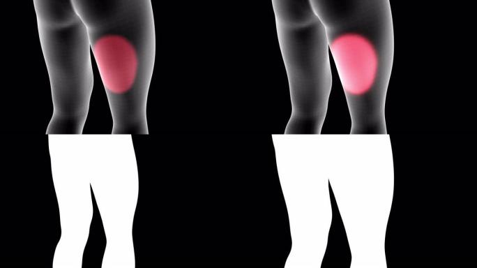 男性x射线全息图的3d动画显示了带有alpha通道的腿部大腿背部区域的疼痛区域