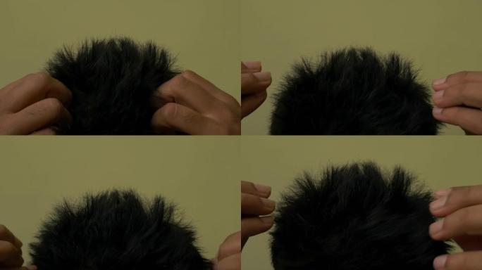 亚洲男子头皮屑导致头发脱落