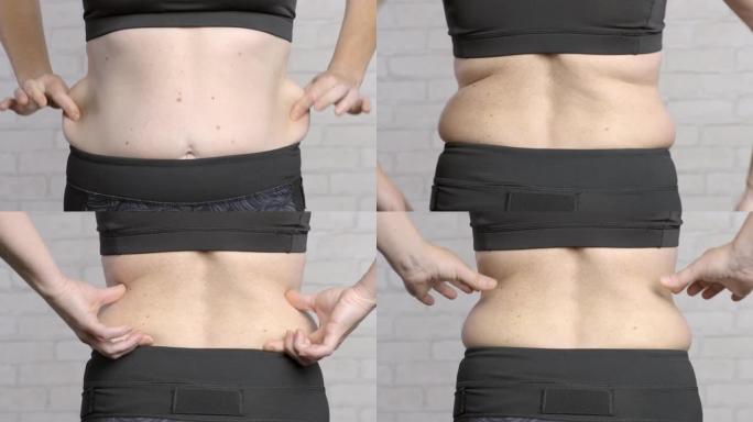 女人腰部多余的脂肪。女人用手从腹部和背部拉出松弛的皮肤
