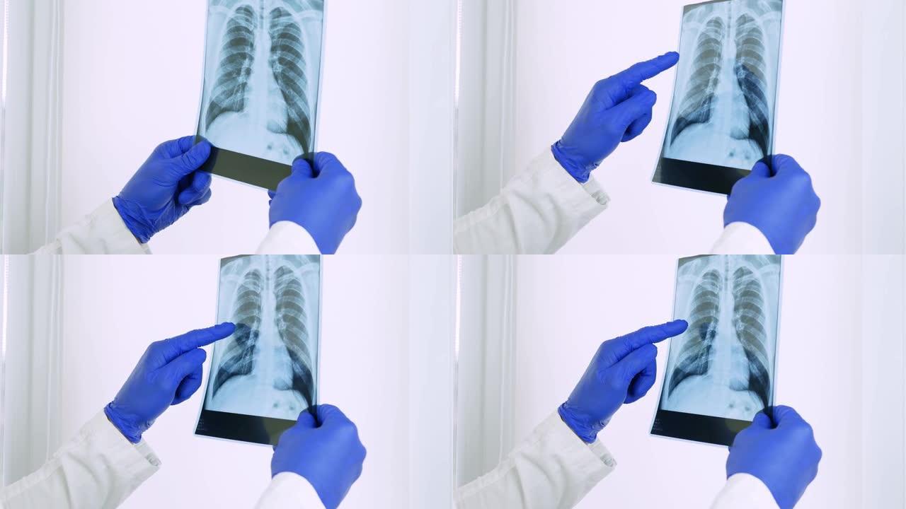 医生手中的肺部x光，研究一个人的病情，肺炎，在医院诊断，肺水肿的特写。