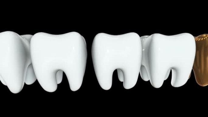 一排白色牙齿中的金色牙齿。3D渲染。牙科，出众，经营理念