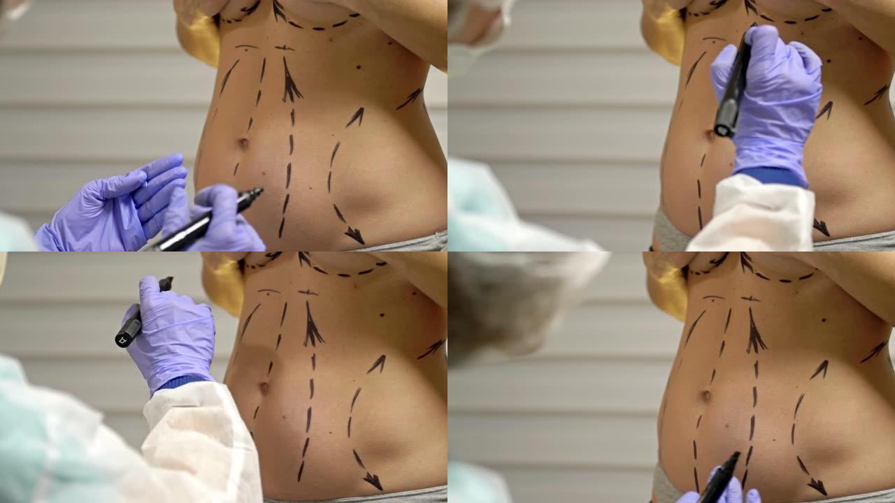 整形外科医生为抽脂手术准备病人。医生用记号笔在女性身上画线