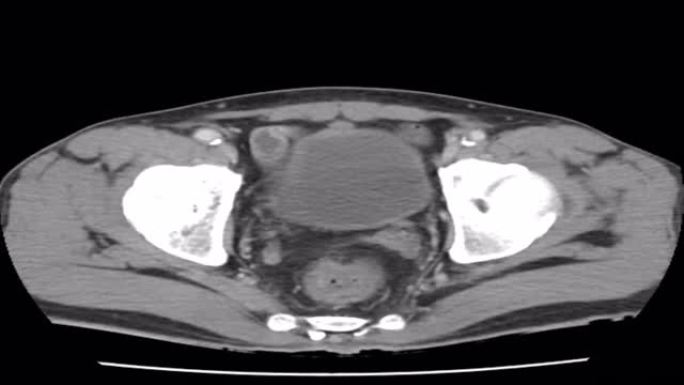 CT轴位扫描诊断腹主动脉瘤4k