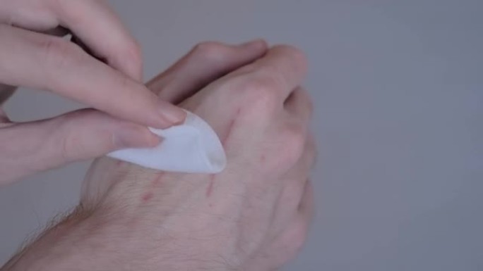 男子试图用棉垫和过氧化氢治疗猫的抓痕: 特写
