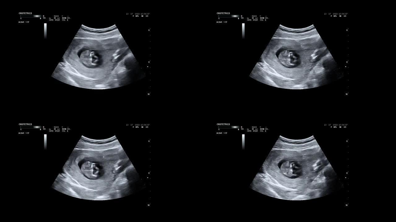 母亲子宫内婴儿的超声检查。婴儿身体和脊柱的超声波。小婴儿正在母亲的肚子里翻身。12周的生命。孕妇的超