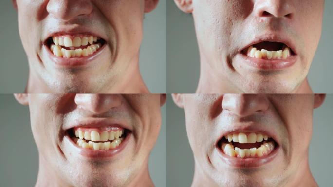 这个人展示了他黄色的弯曲和突出的牙齿。错牙合。特写。